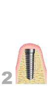 Implantat Sockel einsetzen