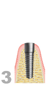 Implantat Sockel 2 einsetzen